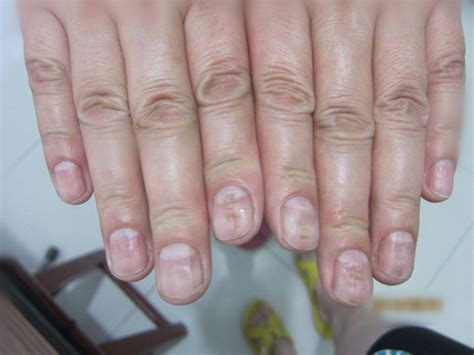 严重缺钙手指甲图片