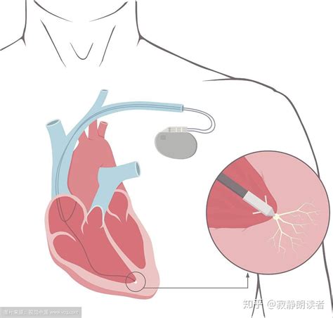 体外心脏起搏器 什么情况使用