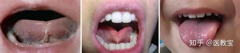 分舌手术后如何控制2个舌头