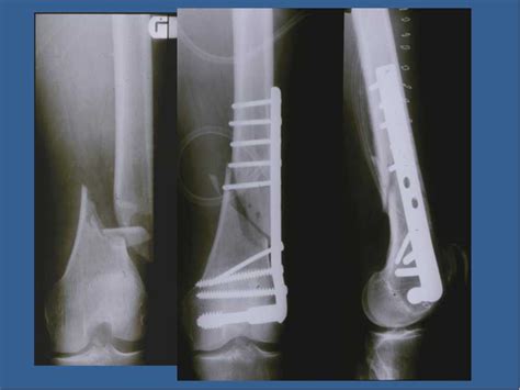 双腿骨折做手术多久可以走路