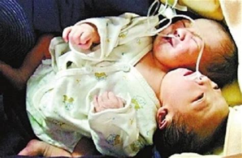 四川产妇产下中国首例女婴