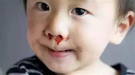 小孩流鼻血的原因