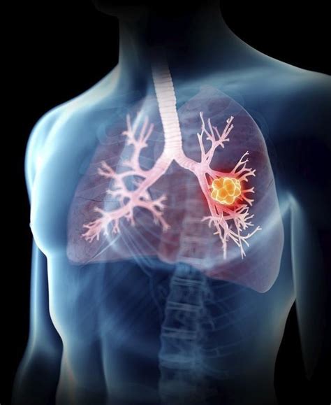 左上中心型肺癌一般存活期