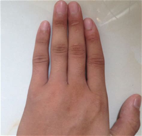 左手中指和无名指胀痛是什么原因