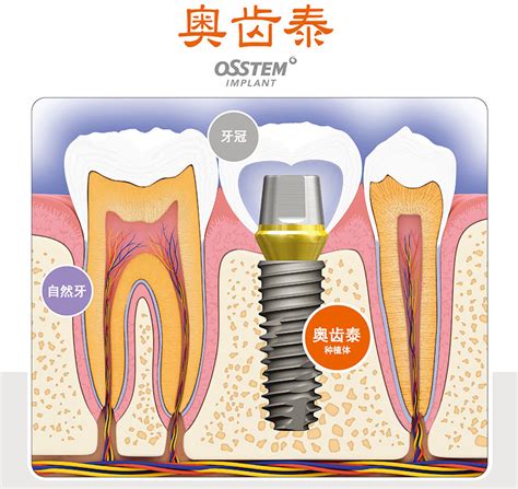 常规种植牙齿的流程