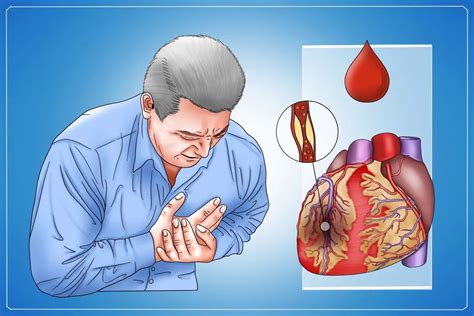 心脏梗塞是怎么造成的