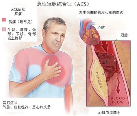 急性冠脉综合征的危险因素