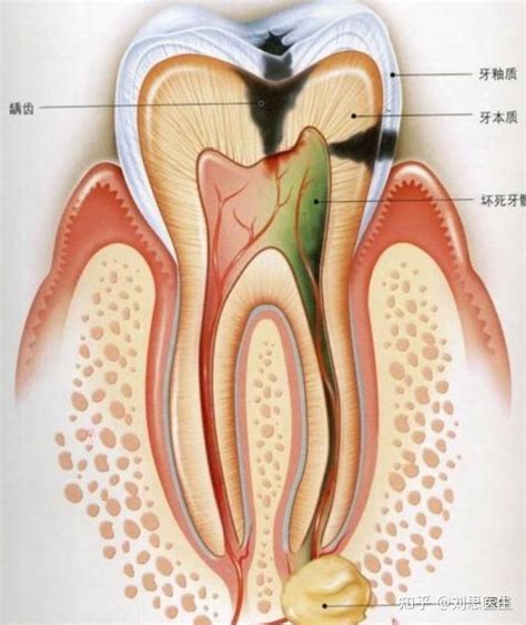 急性牙髓炎一般疼几天