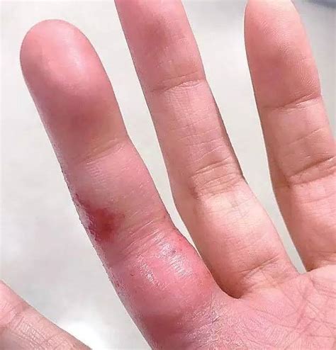 手指被篮球戳肿了会变短吗