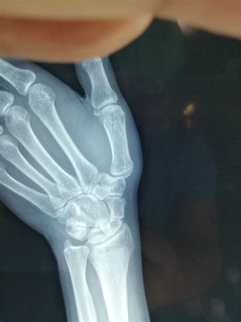 手腕骨折六个月完全恢复了吗
