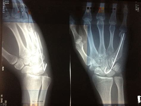手腕骨折后一个月恢复到什么程度