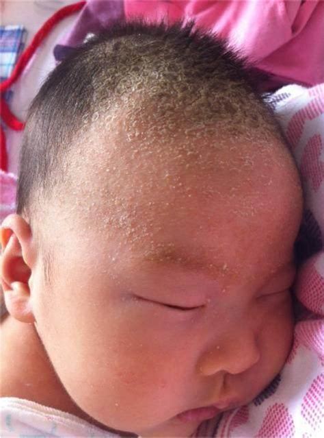 新生儿乳痂图片