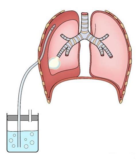 气胸胸腔闭式引流管的护理