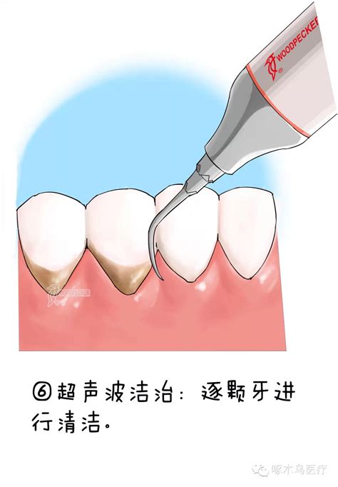 洁牙室接诊流程