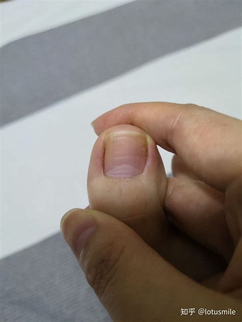 灰指甲初期图片