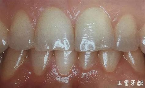 牙周病引起的牙龈出血怎么治疗