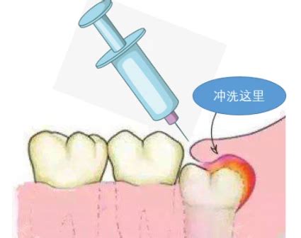 牙龈引流排脓全过程