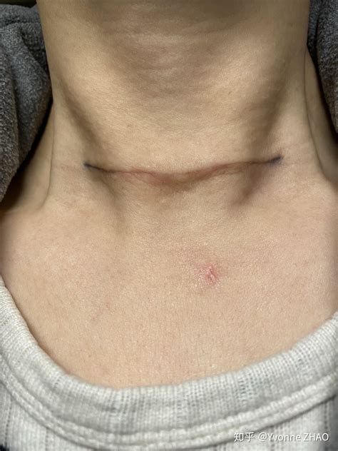 甲状腺手术伤口图片