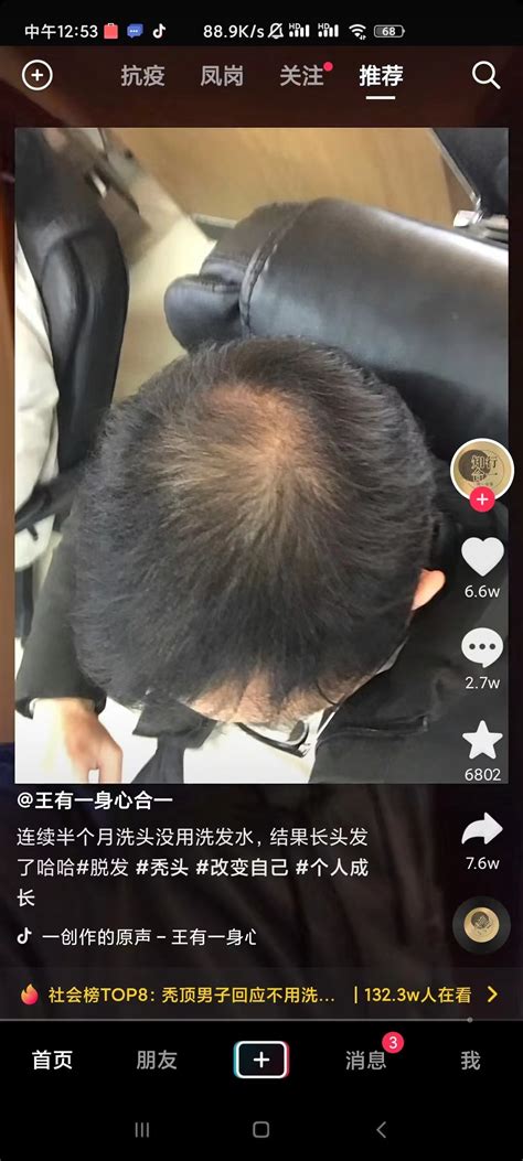 男子秃顶停用洗发水后长出头发