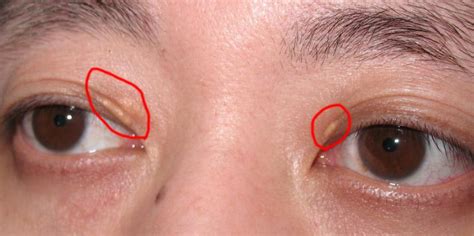眼周有斑是什么原因引起的