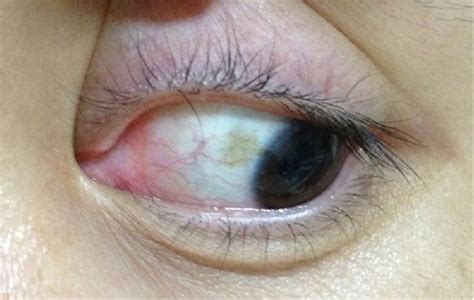 眼周有斑是什么病
