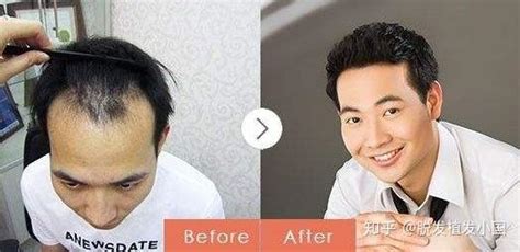 种头发手术
