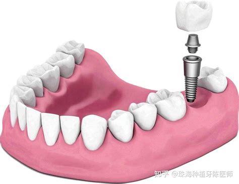 种植牙手术流程规范