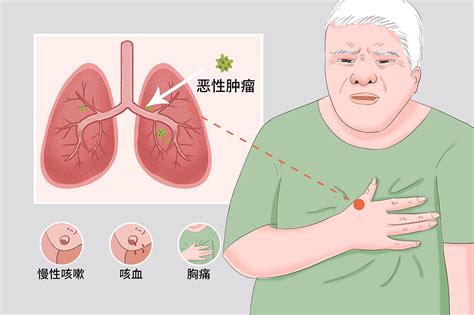 肺癌早期症状和前兆