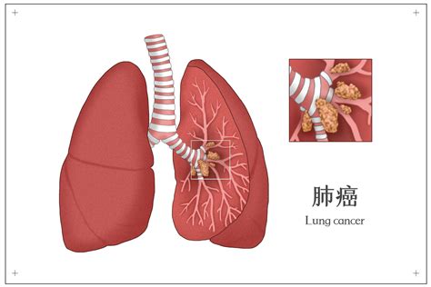 肺癌的前期征兆是什么