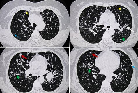 肺部诊断结果图片