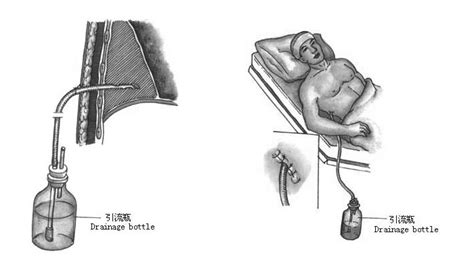 胸腔闭式引流术后指导