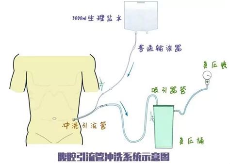 腹腔引流管流程图