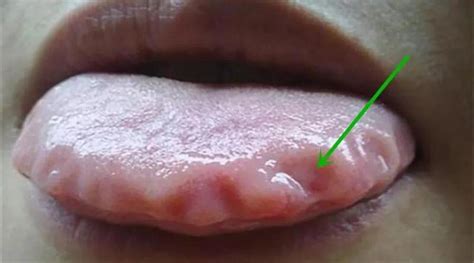 舌头上有齿痕怎么调理