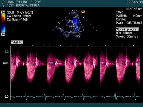 超声心电图和心动图的区别