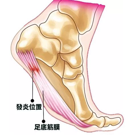 足底筋膜炎有2个痛点