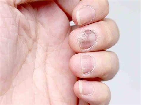 长期灰指甲有什么危害