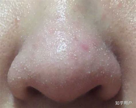 鼻子周围起粉刺什么原因