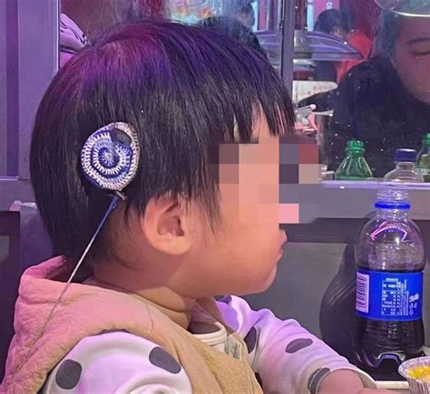 3岁孩子丢失耳蜗