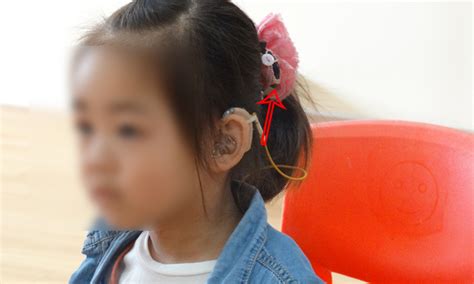 6岁女孩丢失人工耳蜗