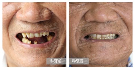 70岁老人可以种牙