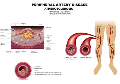peripheral arteries disease