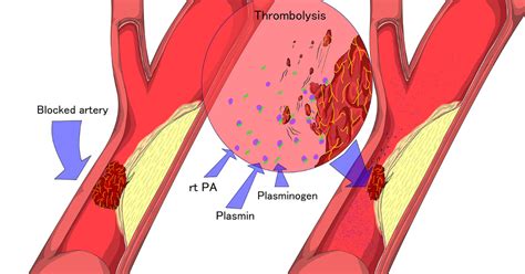 thrombolysis